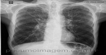 APROVADA PELA ANVISA NOVA DROGA PARA DPOC NO BRASIL
